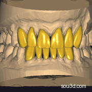 Exocad戈尔韦3.0 前牙冠项目